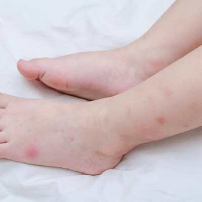 Here’s how to identify insect bites quickly