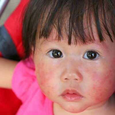 Skin Rashes – Common Types and Causes