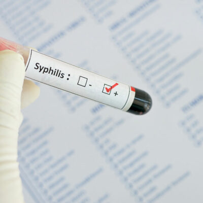 Syphilis – Early Signs and Diagnosis